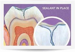 Pit & fissure sealant