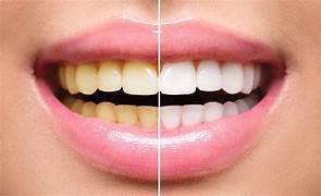 Teeth whitening (bleaching)