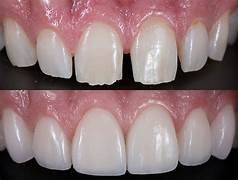 Veneers and laminates