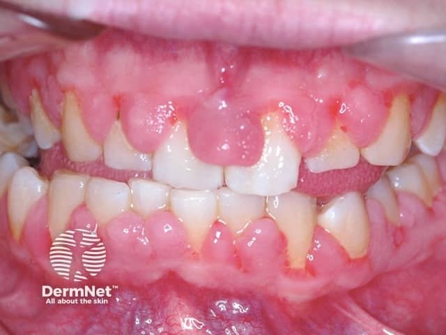 Gingivectomy