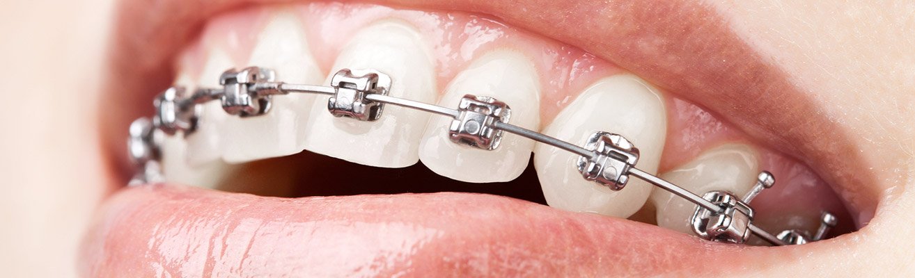 Self ligating braces
