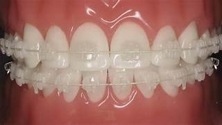 Ceramic self ligating braces