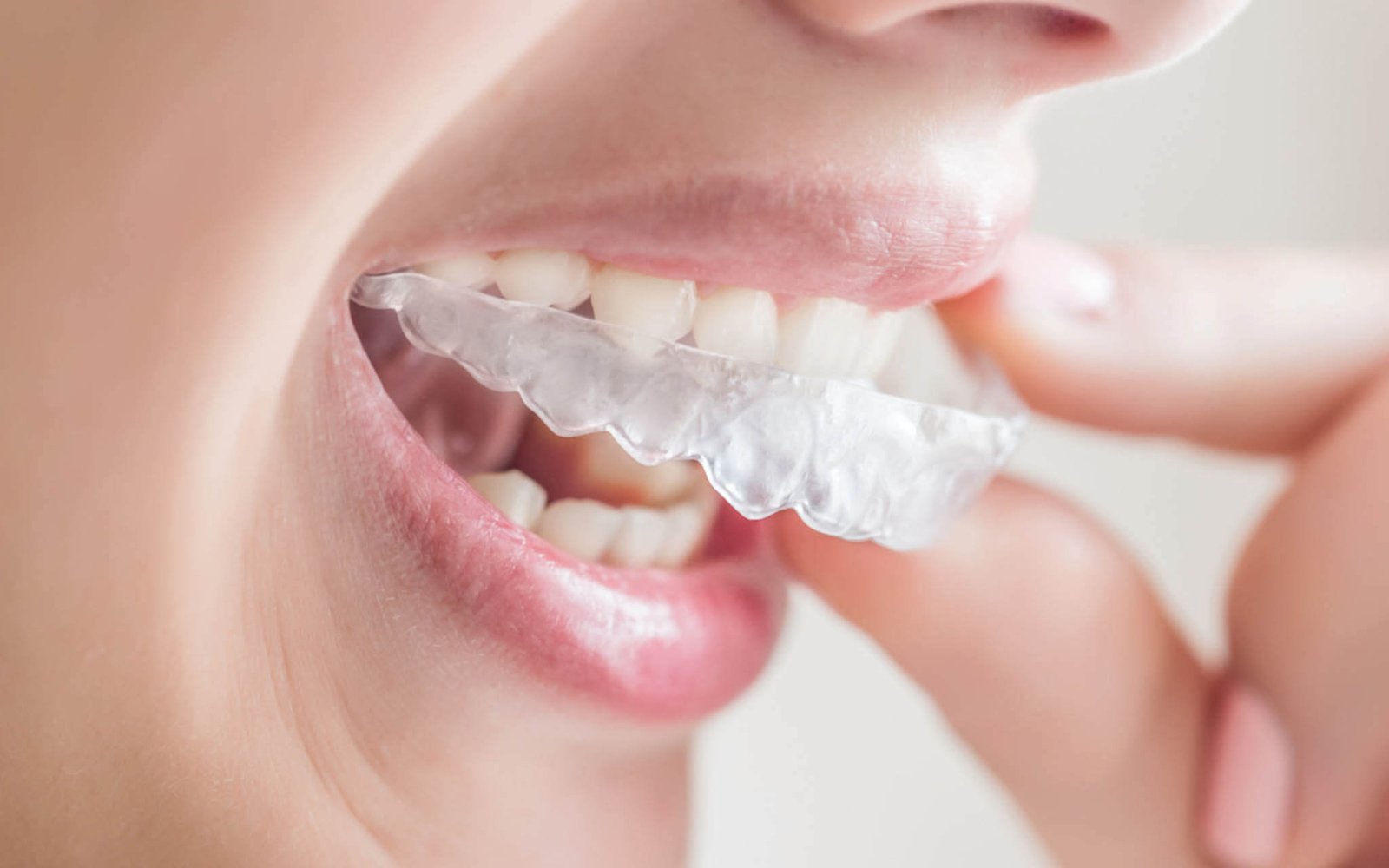 Invisalign aligners