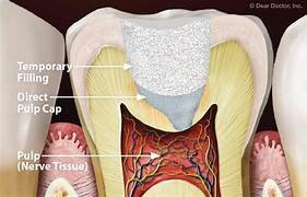 Direct pulp capping